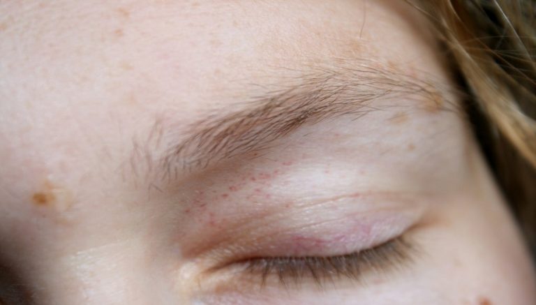 how-to-treat-itchy-eyes-naturally