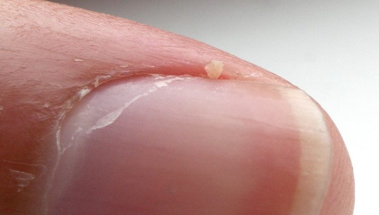 six-common-nail-problems-from-fungus-to-hangnails