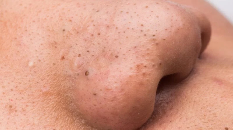Blackheads and Pimples