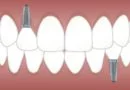 Dental implants