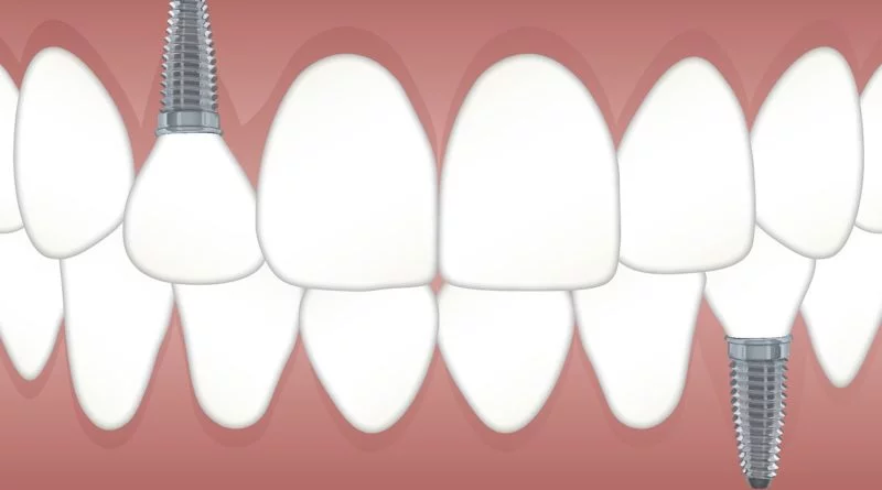 Dental implants